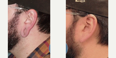 Man treated with Earlobe Repair - Man treated with Earlobe Repair