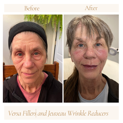 65-74 year old woman treated with Lip Fillers, Cheek Fillers, Jeuveau, DefenAge, Dermal Fillers - This female client wanted to prevent look a little younger and more refreshed to match her energy level.