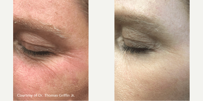 Woman treated with Subnovii Plasma Pen - Woman treated with Subnovii Plasma Pen