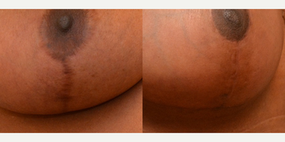 Embrace Scar Therapy used on secondary breast reduction patient - This close-up shows the&nbsp;difference embrace scar therapy makes. In the first photo, you can see the thick, dark, raised scar that resulted from a breast reduction she had undergone years prior. After performing her secondary reduction, I used embrace scar therapy in the weeks following her surgery which&nbsp;improved her healing.