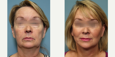 55-64 year old woman treated with Facelift - Patient had facelift with platysma and SMAS work, as well as a chin implant placed.