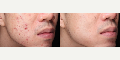 Man treated with Dermapen - Man treated with Dermapen
