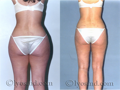 Liposuction - 
	28-year-old woman before and after tumescent liposuction with removal of 12 pounds of fat.

