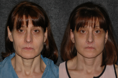 Lip Repositioning - Lip Lift + Deep Plane Facelift