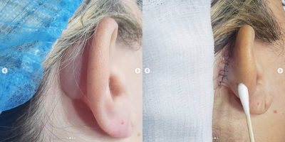 Woman treated with Cyst Removal - Surgical removal of an encapsulated congenital hemangioma. Patient has had this tumor for more than 20 years. It was previously treated as a cyst with multiple attempts to drain the cyst. The lesion grew over time and caused ear deformity, pain and discomfort.