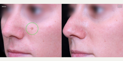 Woman treated with ActiveFX - Woman treated with ActiveFX