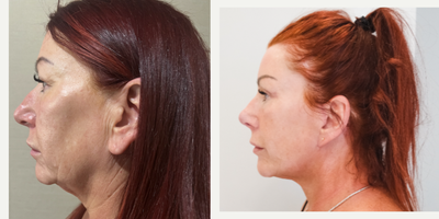 45-54 year old woman treated with Facelift, Rhinoplasty, Neck Lift, Facial Fat Transfer, Botox - Our beloved patient had face-necklift, temporal lifting, rhinoplasty, upper blepharoplasty, facial fat transfer.