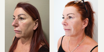 45-54 year old woman treated with Facelift, Rhinoplasty, Neck Lift, Facial Fat Transfer, Botox - Our beloved patient had face-necklift, temporal lifting, rhinoplasty, upper blepharoplasty, facial fat transfer.