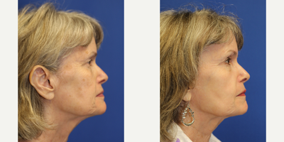 65-74 year old woman treated with TCA Peel - Dr. Katzen used a TCA chemical peel to treat the discoloration of this patient's face.
