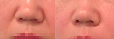 ArteFill Before and After, 51 year old female  - 51 year old female came for smile lines treatment. The results were shown immediately.