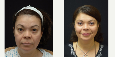 45-54 year old woman treated with Lower Face Lift and Upper/Lower Blepharoplasty - 45-54 year old woman treated with Lower Face Lift and Upper/Lower Blepharoplasty