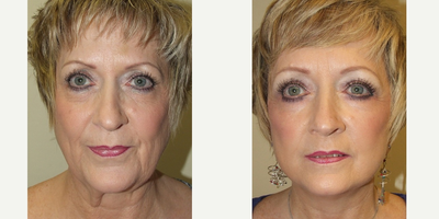 55-64 year old woman treated with Quick Lift - 64 year old woman who underwent facial surgery including Quick Lift, Neck Lift and Lower Eyelid surgery