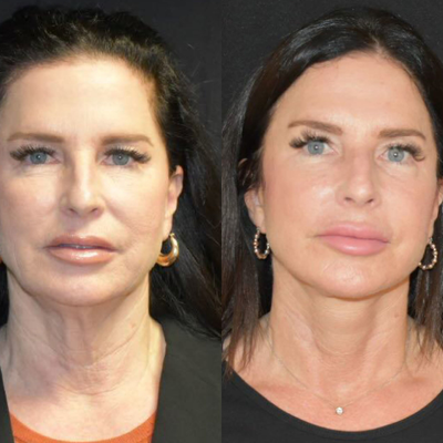55-64 year old woman treated with Facelift, Neck Lift, Facial Fat Transfer - 6 months post op Facelift/ neck lift with fat transfer to face