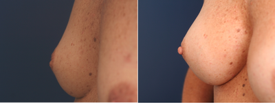 25-34 year old woman treated with Nipple Surgery - Correction Grade III Inverted Nipples