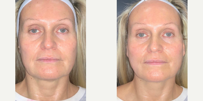 45-54 year old woman treated with Nonsurgical Facelift, Contour Thread Lift - Non-surgical face lift by Dr. Sandhu using PDO Threads.