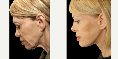 71 year old woman treated with MyEllevate, Nonsurgical Neck Lift, Neck Lift - 71 year old female who was complaining of the sagging appearance of her neck, prominent platysma muscle bands, and loss of definition of the jawline. The MyEllevate system was utilized to enhance the jawline appearance with a continuous permanent U-shaped suture support system that was placed with a specialized light-guided device through tiny skin punctures just below the mandible and then tightened to achieve the desired effect.The system also enabled a division of the visible platysma muscle bands on either side of the midline through similar puncture sites in the skin to enhance the neck contour. Finally, a limited skin tuck, known as MyEllevate Plus, was performed to further improve the appearance of the jowls and the neck.