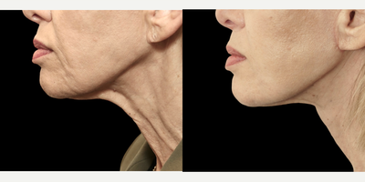 71 year old woman treated with MyEllevate, Nonsurgical Neck Lift, Neck Lift - 71 year old female who was complaining of the sagging appearance of her neck, prominent platysma muscle bands, and loss of definition of the jawline. The MyEllevate system was utilized to enhance the jawline appearance with a continuous permanent U-shaped suture support system that was placed with a specialized light-guided device through tiny skin punctures just below the mandible and then tightened to achieve the desired effect.The system also enabled a division of the visible platysma muscle bands on either side of the midline through similar puncture sites in the skin to enhance the neck contour. Finally, a limited skin tuck, known as MyEllevate Plus, was performed to further improve the appearance of the jowls and the neck.