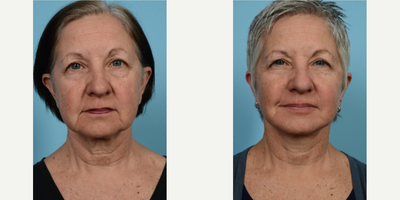 Woman treated with Lower Facelift - Woman treated with Lower Facelift