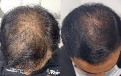 45-54 year old man treated with Mesotherapy - Patient after 1 month of Mesotherapy (1 day/ week)