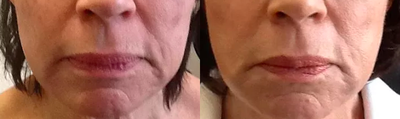 65-74 year old woman treated with NOVA PDO Thread lift. - Non-surgical thread lift of marionette area.