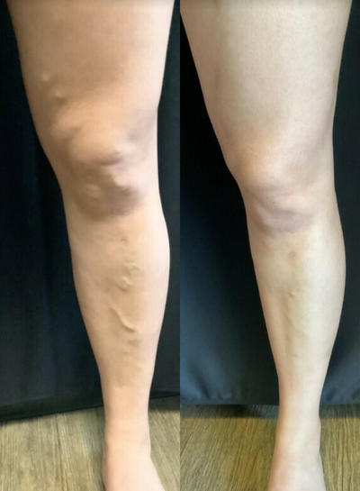 Woman treated with Sclerotherapy - Woman treated with Sclerotherapy