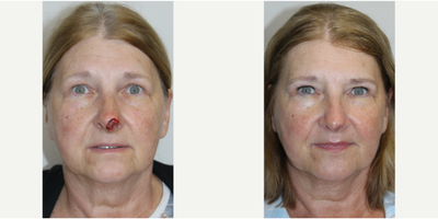 Patient treated with Mohs Surgery and Facial Reconstructive Surgery - Patient treated with Mohs Surgery and Facial Reconstructive Surgery