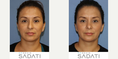 Orange County SeptoRhinoplasty Procedure - SeptoRhinoplasty Procedure to correct breathing and sleeping problems as well as droopy tip and nasal hump.