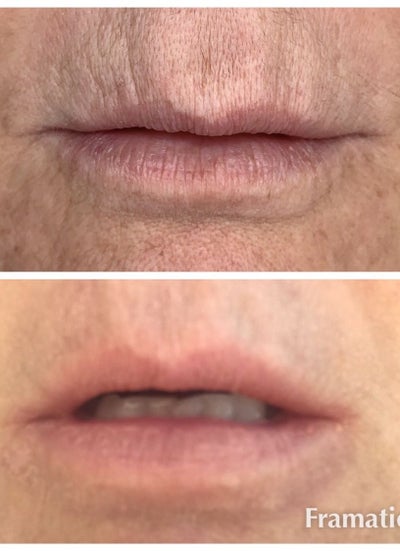 Plasma Fibroblast Review Realself