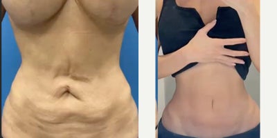 35-44 year old woman treated with Panniculectomy, Liposuction - Double reverse tummy tuck with umbilical lift and liposuction for isolated upper abdominal loose skin