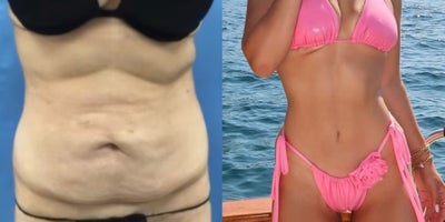 25-34 year old woman treated with Panniculectomy - 100+ lbs weight loss after sleeve gastrectomy + nutritional counseling now 6 months after excess skin excision with athletic body contouring (Vaser Lipo) with creation of scarless umbilicus showing off  her results in Positano!