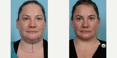 Woman treated with PrecisionTx - Woman treated with PrecisionTx