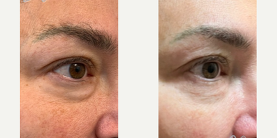 Woman treated with Microneedling RF - Say goodbye to your tired under-eye with VirtueRF's ExactRF handpiece! The ExactRF handpiece's single needle targets the delicate under-eye region to eliminate undereye bags and reduce fine lines and wrinkles.
