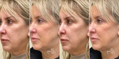 45-54 year old woman treated with Nonsurgical Facelift - InstaLift results at The Skin Center, Columbus!