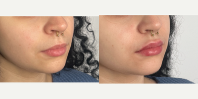 25-34 year old woman treated with Lip Fillers, Revanesse - patient treated with 0.8ml of revanesse lips