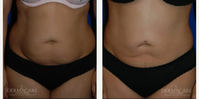 Woman treated with Tickle Lipo - Woman treated with Tickle Lipo