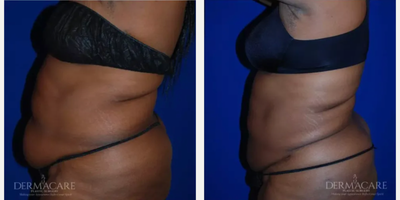 Woman treated with Tickle Lipo - Woman treated with Tickle Lipo