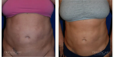 Woman treated with Tickle Lipo - Woman treated with Tickle Lipo