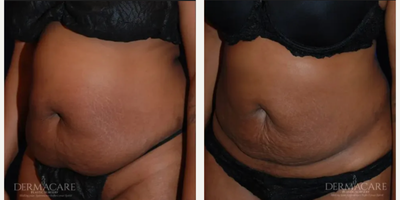 Woman treated with Tickle Lipo - Woman treated with Tickle Lipo