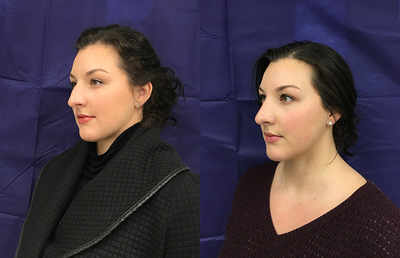 Woman treated with Rhinoplasty - Woman treated with Rhinoplasty.