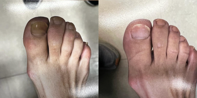 45-54 year old woman treated with Laser Toenail Fungus Removal - 4 months apart after laser onych treatment of the toenails for fungus removal