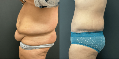 Case #175 - tummy tuck abdominoplasty