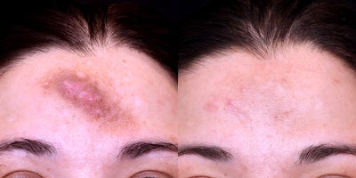 25-34 year old woman treated with Clear and Brilliant Laser Resurfacing - Another amazing transformation using Clear and BrilliantThis patient came to our office hoping to treat persistent pigmentation on her forehead. After just three treatments, her skin shows noticeable improvement in tone, texture, and overall radiance.This gentle laser targets pigmentation, boosts collagen, and enhances skin quality all with little to no downtime.