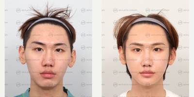 18-24 year old man treated with Jaw Reduction, Genioplasty, Cheekbone Reduction, Rhinoplasty, Asian Rhinoplasty, Canthoplasty, D - Mandible Jaw Reduction, Cheekbone Reduction, GenioplastyRhinoplasty (Nose Ridge+Nose tip+Hump Reduction+Osteotomy+Bulbous Nose Correction)Non-Incisional Double Eyelid Lateral Canthoplasty+Lower Lateral Canthoplasty
