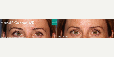 Woman treated with YAG Laser - Cynergy and ResurFX lasers to treat forehead scar