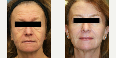 55-64 year old woman treated with Silhouette InstaLift - This patient wanted a refreshed look. She was treated with Silhouette Instalift, Botox and Juvederm.
