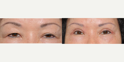 65-74 year old woman treated with Asian Eyelid Surgery - This is an Asian woman that underwent upper eyelid surgery to remove the heavy upper lid skin (Blepharoplasty) as well as lift her upper eyelids (ptosis repair).