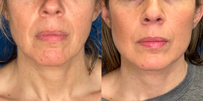 45-54 year old woman treated with Laser Liposuction, Miracu, Nonsurgical Facelift, Nonsurgical Neck Lift,   - Endolift Laser: Facial Rejuvenation using Laser Technology to tighten loose and wrinkled skin along with contouring bulging fat pockets.Board Certified Plastic Surgeon and International Artist, Dr. Jeffrey Rosenthal is fortunate tooffer the Endolift.This revolutionary Laser uses a micro fiber-optic cable placed beneath the skin to stimulate collagen.Unlike other technologies that heat the outer skin, the Endolift Laser focuses on the target tissues beneath the skin, without burning the outer tissues.This results in direct stimulation of the deeper dermis to produce collagen and tighten the overlying skin without the potential side effects of outer skin damage, pigmentation and pain.The FDA approved Endolift Laser is used throughout Europe and was created in Italy. Despite its popularity throughout the world, this powerful and effective Laser is in less than 30 offices across America.Lax skin and or small pockets of fat can be improved in the brows, lids, inner arms, inner knees, thighs and the abdomen.This is an in office, walk in - walk out procedure with little down time and minimal discomfort.