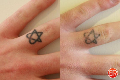 Tattoo Removal - Before & After 1 treatment of Tattoo Removal. This patient will need approx. 2-3 more sessions for complete removal.