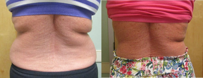 Woman treated with BodyFX - Woman treated with BodyFX to treat stubborn pockets of fat located just under herbra area.