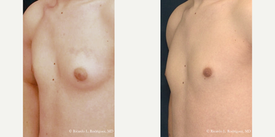 Male Breast Reduction - 18-24 year old man treated with Male Breast Reduction